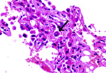 Microscopic view of a tissue sample stained in purple with an arrow indicating a particular area of interest, possibly highlighting a cellular abnormality or a key feature for diagnostic purposes.